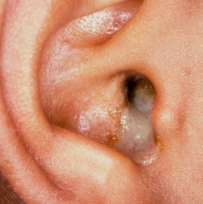 Akıntılı Kulak Hastalıklar